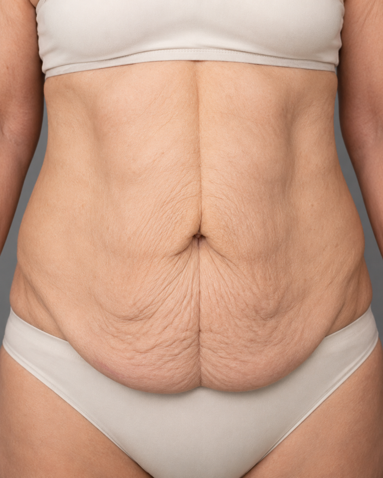 Tummy Tuck
