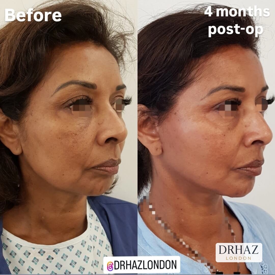 Face-lift (11)