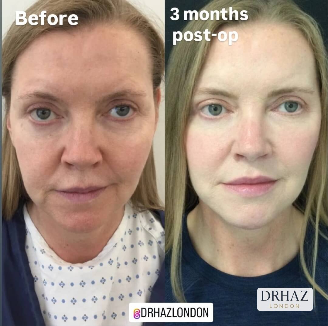 Face-lift (8)