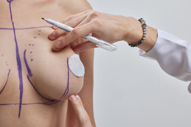 Breast Implant Replacement