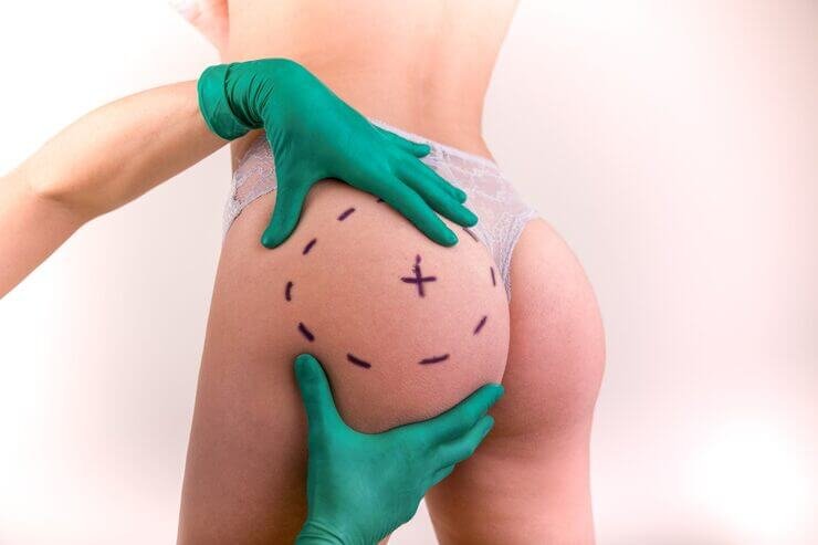 Sculptra for Buttock Augmentation